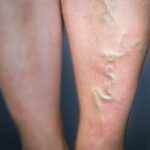 Reasons To Get Your Varicose Veins Treatment